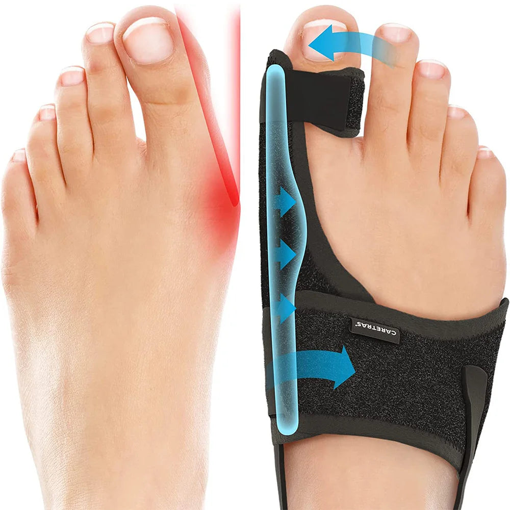 Toe Correction Hallux Valgus Corrector Straightening Big Toe Orthotics Stainless Steel Support Strap Feet Separator Bunion