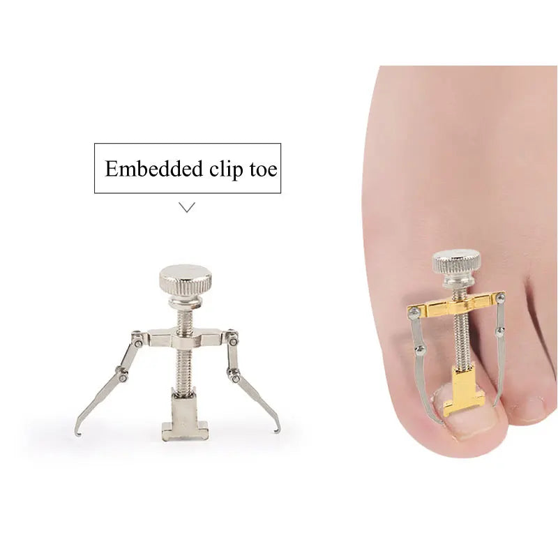 Correction of Paronychia with Toe Nail Correction Bracket for Treatment of Toe and Toe Care with Toe Fixator