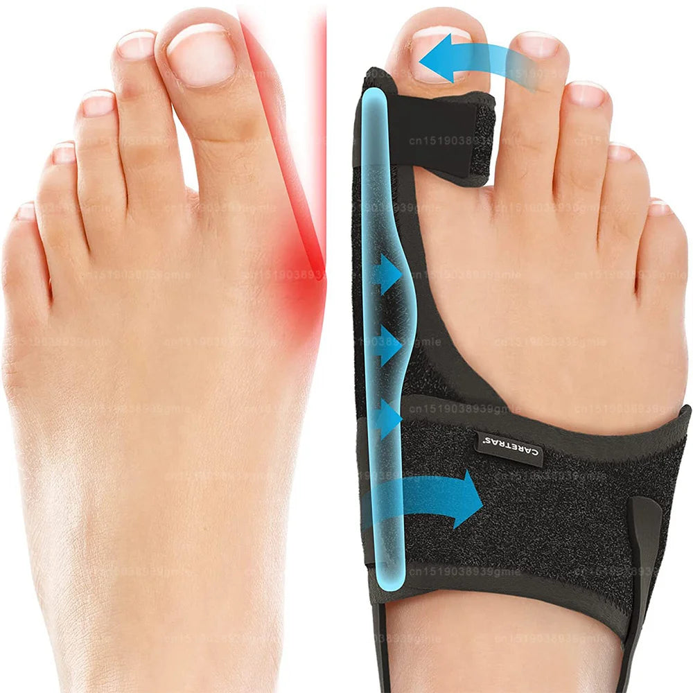 Toe Correction Hallux Valgus Corrector Straightening Big Toe Orthotics Stainless Steel Support Strap Feet Separator Bunion